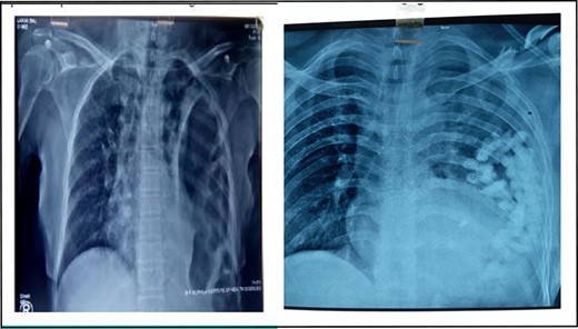 X-ray chest showing collapsed left lung with herniated bowel loops in left thoracic cavity.