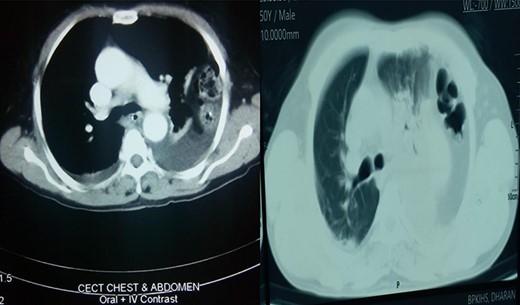 Axial section showing collapsed left lung with bowel in left thoracic cavity.