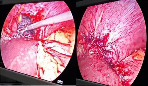 Defect in left hemidiaphragm with visible collapsed lung and closure of defect.
