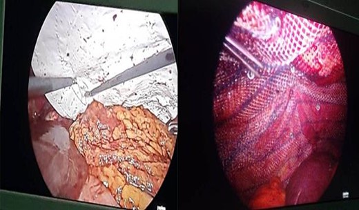 Strengthening of defect closure site with composite and polypropylene mesh.