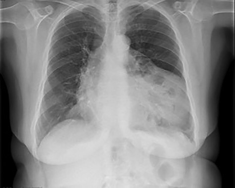 Chest X-ray showing widening of the mediastinum and a few air-fluid levels