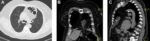 (a–c) Axial, coronal and sagittal images, respectively, of thoracic and abdominal CT showing the localization of this hernia.