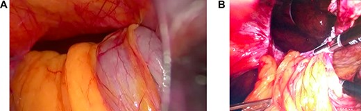(a and b) Photographs taken during surgery: herniated colon and ‘omentum,’ and after reduction of these contents, respectively.