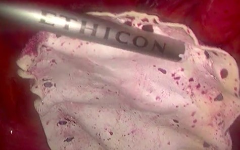 Photograph taken during surgery: placement and fixation of the mesh.