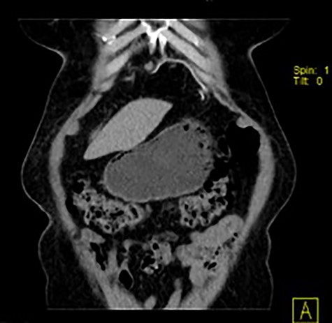 Coronal image of thoracic and abdominal CT showing the location of the mesh (linear and hyperdense).