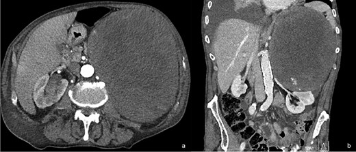 Contrast CT scan of the abdomen of the patient at his admission in the hospital. Axial view showing a left abdominal mass occupying the left upper abdominal quadrant and displacing down the left kidney (a) and renal artery and vein as shown in the coronal view (b).