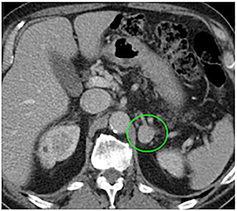 Ten years before abdominal CT scan, provided by the patient, at the time of first diagnosis, showing a 2.3-cm mass at the level of the left adrenal gland (green circle).