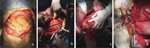 Surgical images, (a) subcostal bilateral incision showing the large retroperitoneal mass growing behind the transverse mesocolon and the left colic flexure; (b) careful isolation of the mass from the surrounding organs; (c) identification and preservation of the left upper pole of the kidney; (d) ligation of a large left adrenal vein joining the left renal vein displaced vertically downward.