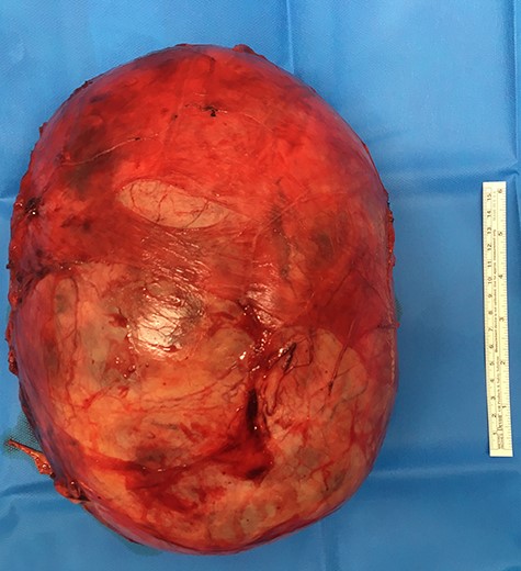 Final image of the mass on the operating table after removal, with its complete capsule.