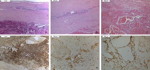 Hematoxylin–eosin sections (a–c) and differential immunohistochemistry (CD31, FLI1, Podoplanin) sections, excluding malignant vascular growth or sarcomas (d–f).