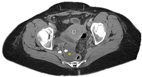Axial image of pelvic collection. U: uterus; *: pelvic abscess cavity; White arrows: rim-enhancing pelvic abscess cavity.