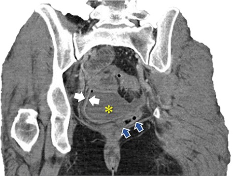 Coronal image of pelvic abscess cavity. *: pelvic abscess cavity; White arrows: rim-enhancing pelvic abscess cavity; Blue arrows: collapsed sigmoid colon with multiple diverticuli.