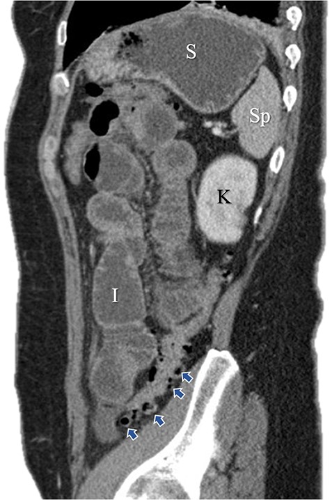 Sagittal image of colonic diverticuli. S: stomach; Sp: spleen; K: kidney; I: ileum; Blue arrows: multiple colonic diverticuli.