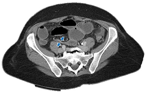 Small bowel obstruction showing air-fluid levels with transition point in the distal ileum. Blue arrows: small bowel obstruction with transition point in distal ileum.