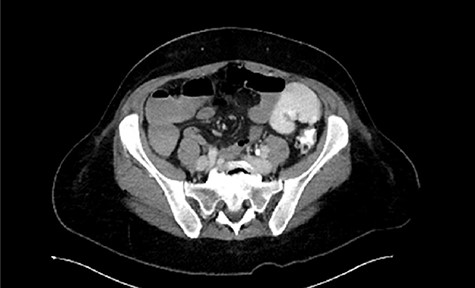 Follow-up CT showing marked improvement of pelvic abscess collection.