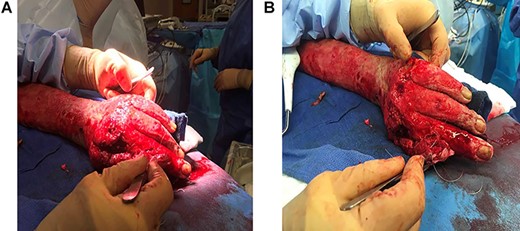 (A and B) Intraoperative photos of the index finger amputation along with the FF covering of the long finger with the salvaged.