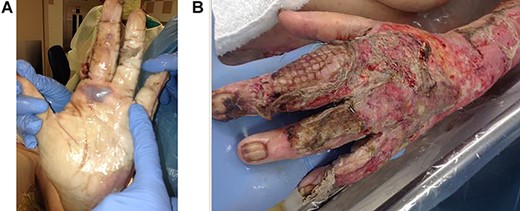 (A and B) Images of the patients’ left hand after repair using the FF technique along with the reconstruction of the central slip of the EDC and the extensor tendon of the EDC.