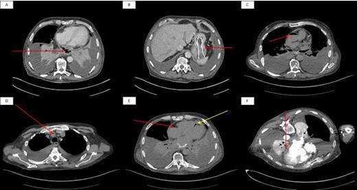 Initial non-contrast enhanced axial CT scan of the thorax. (A): The arrow shows lower oesophageal perforation with cavity containing air and debris in the posterior mediastinum. (B): The arrow shows migration of oesophageal stent into the stomach. A second non-contrast enhanced axial CT scan of the thorax showed air in the ascending aorta (C), brachiocephalic artery (D) and (E) right coronary artery (red arrow) and posterior descending artery (yellow arrow). A final contrast-enhanced axial CT scan of the thorax (prone position) shows loss of the fat plane at the junction of the oesophageal tumour and left atrium.