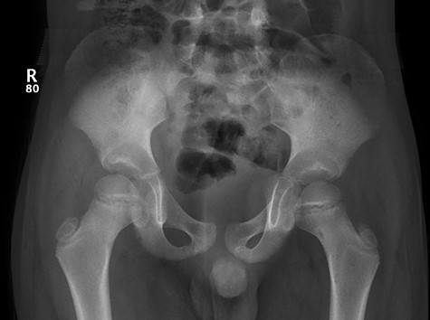 Showed AP view of the pelvis.