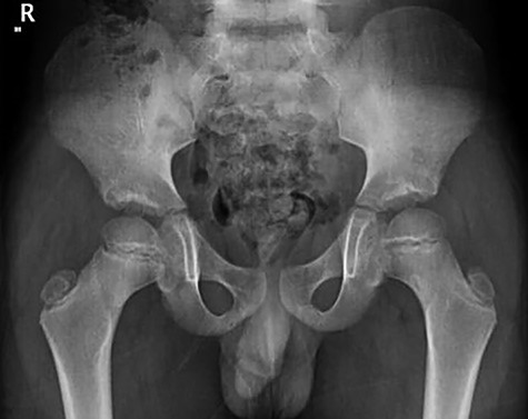 Follow-up AP x-ray pelvis and hips.