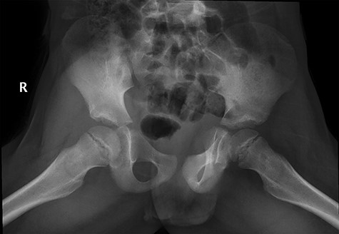 Showed lateral view of the hips with pelvis.