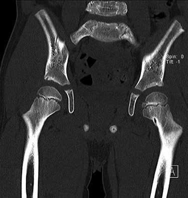 Sowed coronal cut of CT hips demonstrating the synovial pit on left and right side.