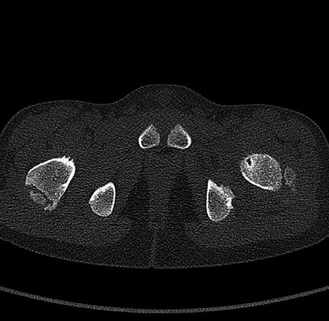 Showed axial cut of CT hips demonstrating the synovial pit on left and right side.