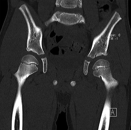 Showed coronal cut of CT hips demonstrating the synovial pit prominent right side.