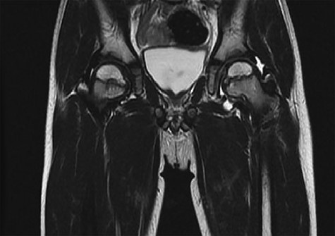 Showed T2 signal MRI coronal cut.