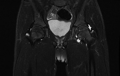 Showed T1 signal of MRI hips.