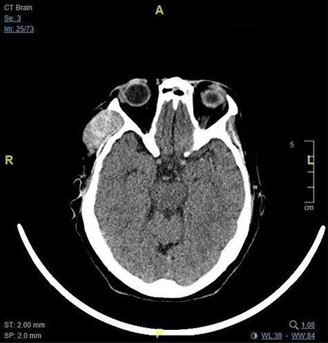 This image shows the 2 x 4 x 4 cm right temporal fossa lesion as seen on CT brain in the axial plane.