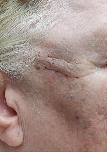 This image shows the post-operative scar in the right temporal region.