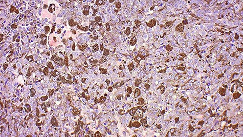 This image shows a tumour comprised of neoplastic epithelioid cells with prominent central nucleoli, most of which feature cytoplasmic melanin.