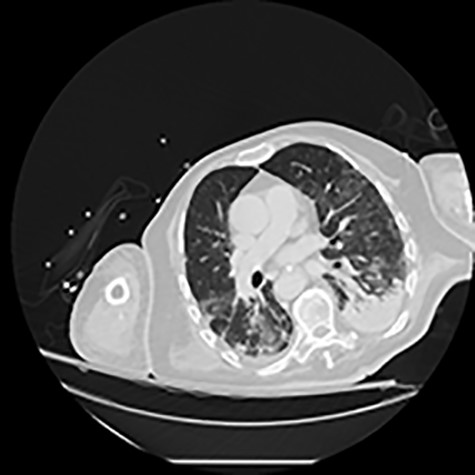 CT of the chest showing bilateral multiple ground glass opacities and areas of consolidation consistent with COVID-19 pneumonia.