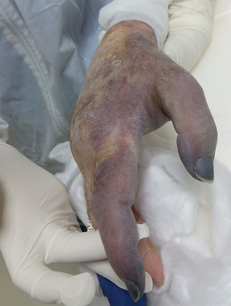 Dry gangrene of the right thumb and index fingers.