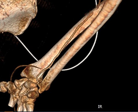 CT angiography of the right upper limb with volume rendering showing complete radial artery thrombosis beginning at the level of the elbow at the same level that embolectomy was performed. Also, there was significant ulnar artery stenosis near occlusion, ~15 cm proximal to the wrist. The ulnar artery appeared to be normal peripherally to the level of obstruction, with no collaterals being visible.