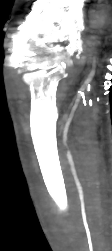 Multiplanar reformation image shows severe near occlusion 6-mm stenosis of the ulnar artery.