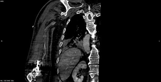 Multiplanar reformation image shows filling defect in the right axillary vein consistent with thrombosis.