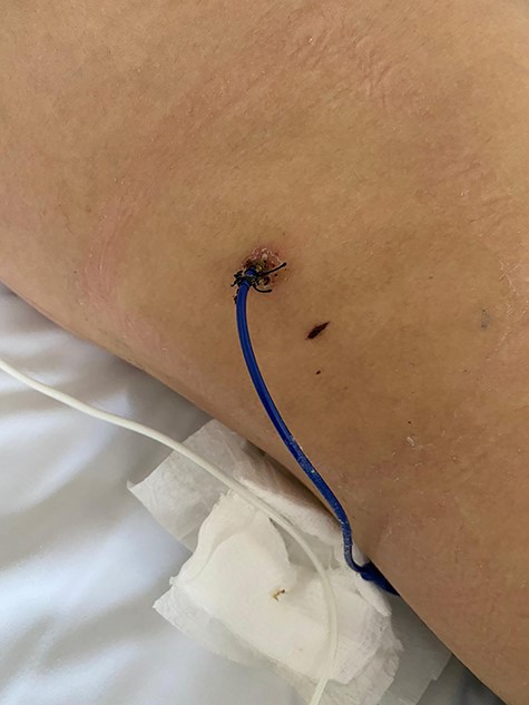 Pig tail catheter on the patient.