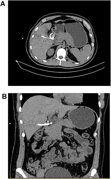 A: CT, the catheter tip can be seen lodged in the duodenal lumen. B: CT, the catheter perforates the duodenal wall.