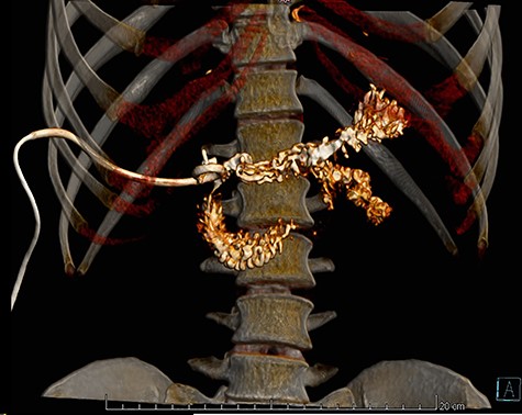 CT reconstruction, the contrast is spreading to the duodenum and small bowel without leaks.