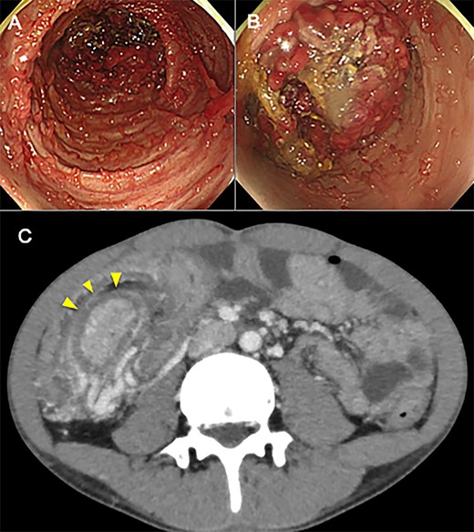 (A, B) Colonoscopy before total colectomy shows multiple polypoid structure throughout the colon, especially in the transverse colon in which colon was in invagination. (C) CT before total colectomy shows an elongated mass lesion in the transverse colon. An oval mass (arrowhead) represents intussuscepted bowel wall, surrounded by mesenteric fat and vessels of the intussuscipiens.