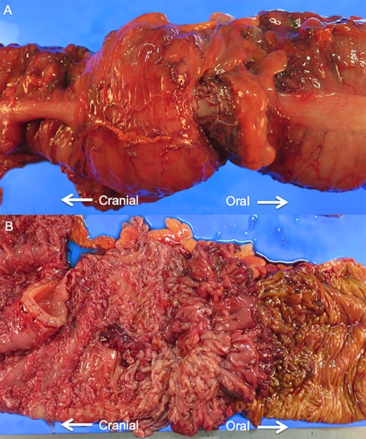 (A) Gross feature of surgical resection specimen. The proximal transverse colon has invaginated into the distal transverse colon. (B) Opened surgical specimen. Numerous inflammatory polyps spread throughout the entire colon.