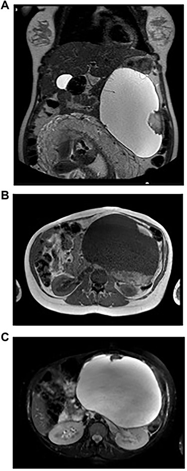 Imaging studies. A: Abdominopelvic T2-weighted coronal MRI – Voluminous left supramesocolic cystic formation (24 cm × 17 cm × 13 cm), with well-defined contours and small septa and parietal vegetation inside. B: Abdominopelvic T1-weighted axial MRI – The lesion with a solid component hyperintense on T1-weighted imaging, translating eventual area of haemorrhage. C: Abdominopelvic T2-weighted axial MRI – The lesion pushed the stomach to the right and the spleen upward, as well as the kidney to the back, apparently without direct invasion of these structures.