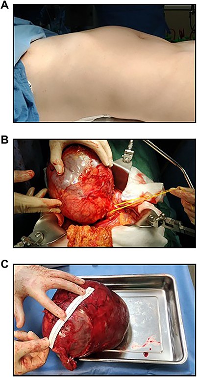 Intraoperative findings and macroscopic observations. A: Preoperative photograph of a postpartumpatient with a large pancreatic MCN. B: A large smooth cystic lesion occupied the body and tail of the pancreas. C: Macroscopic view of the resected tumour.