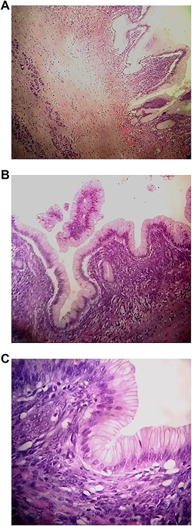 Histological analysis. A: Pancreatic cystic wall (Hematoxylin and eosin stain (HE); ×40 magnification). B: Pancreatic cystic wall lined by foveolar gastric type surrounded by dense ovarian type stroma (HE; ×100). C: Details of epithelium with low grade dysplasia (HE; ×400).