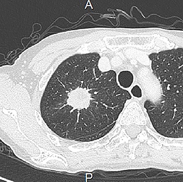 Chest CT showed a 32-mm diameter solid mass in the right upper lobe.