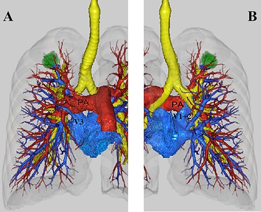 (A) Anterior view on three-dimensional computed tomography (3D-CT). V1 + 2 ran behind the pulmonary artery. V3 was located superiorly on the most ventral side of the hilum. (B) Posterior view on 3D-CT. V1 + 2 ran in front of the bronchus (PA: main pulmonary artery).