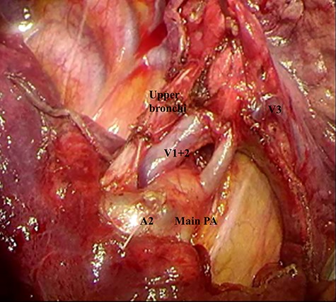 The operative findings in this patient after V3 and A2 ligation. V1 + 2 was recognized between the main pulmonary artery and the bronchus intermedius.