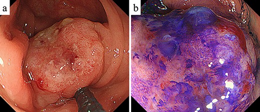 Colonoscopy. (a) Colonoscopy revealed a Type I tumor with depression and fullness in the ascending colon; (b) according to the Kudo pit pattern classification, this tumor was VI high grade.